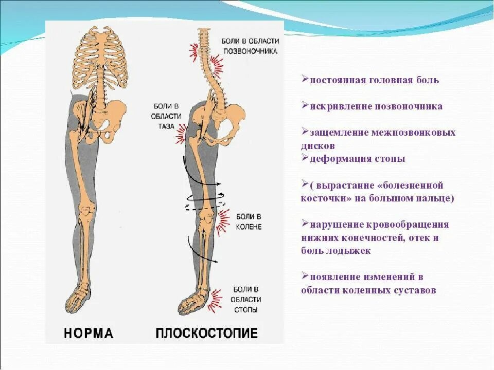 Плоскостопие и позвоночник связь. Стопы и позвоночник взаимосвязь. Плоскостопие искривление таза.