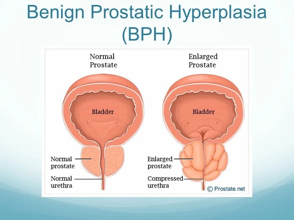 Размер мочевого пузыря у мужчин. Метод исследования benign prostatic hyperplasia. Benign prostatic hyperplasia Epidemiology.