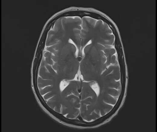 Менингиома головного мозга. Коллоидная киста 3 желудочка мрт. Коллоидная киста 3 желудочка головного мозга кт. Фалькс менингиома головного. Коллоидная киста головного мозга кт.