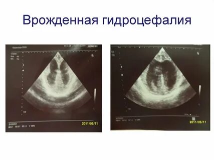 Гидроцефалия киста