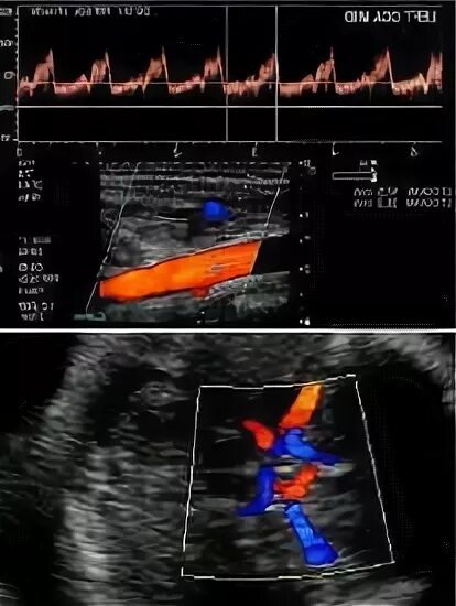 узи головы и шеи сосудов цена кострома сергей. ультразвуковое исследование брахиоцефальных артерий у детей. узи сосудов головы.