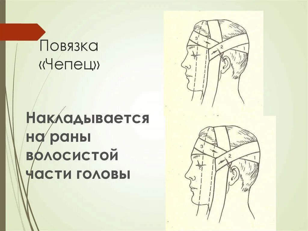 Бинтование чепец. Перевязка чепец на человеке. Наложение повязки на голову чепец. Чепец перевязка схема. Повязка на голову десмургия чепец.