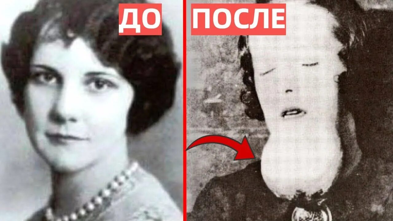 Молли мэгги радиевая девушка. Кэтрин донахью радиевые девушки. Молли мэгги радиевая девушка. Фото баерса радиева челюсть. Женщина без нижней челюсти.