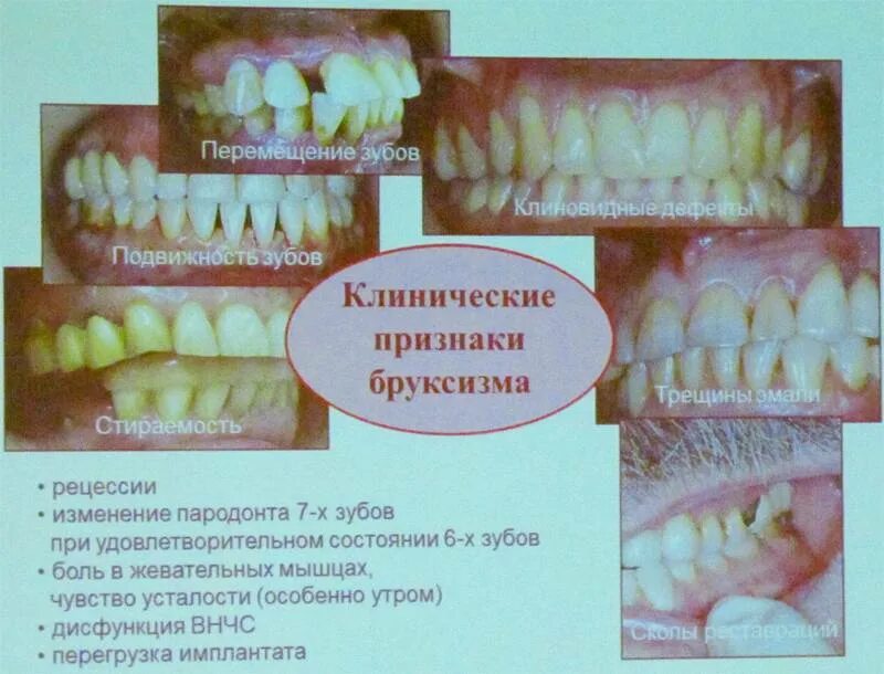 Почему сжимаются зубы. Человек скрипит зубами во сне. Почему скрипят зубами во сне.