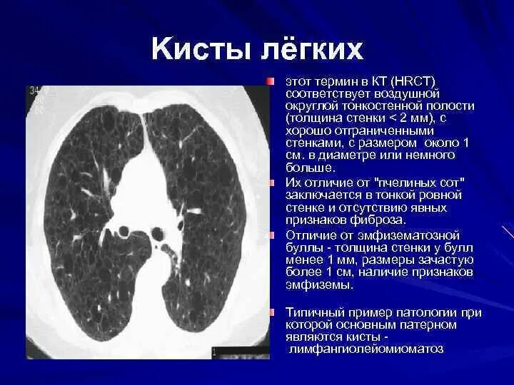 Буллёзная эмфизема верхних долей лёгких. Панлобулярная эмфизема на кт. Апикальная буллезная эмфизема. Эмфизема легких кт. Что значит легкие расширены