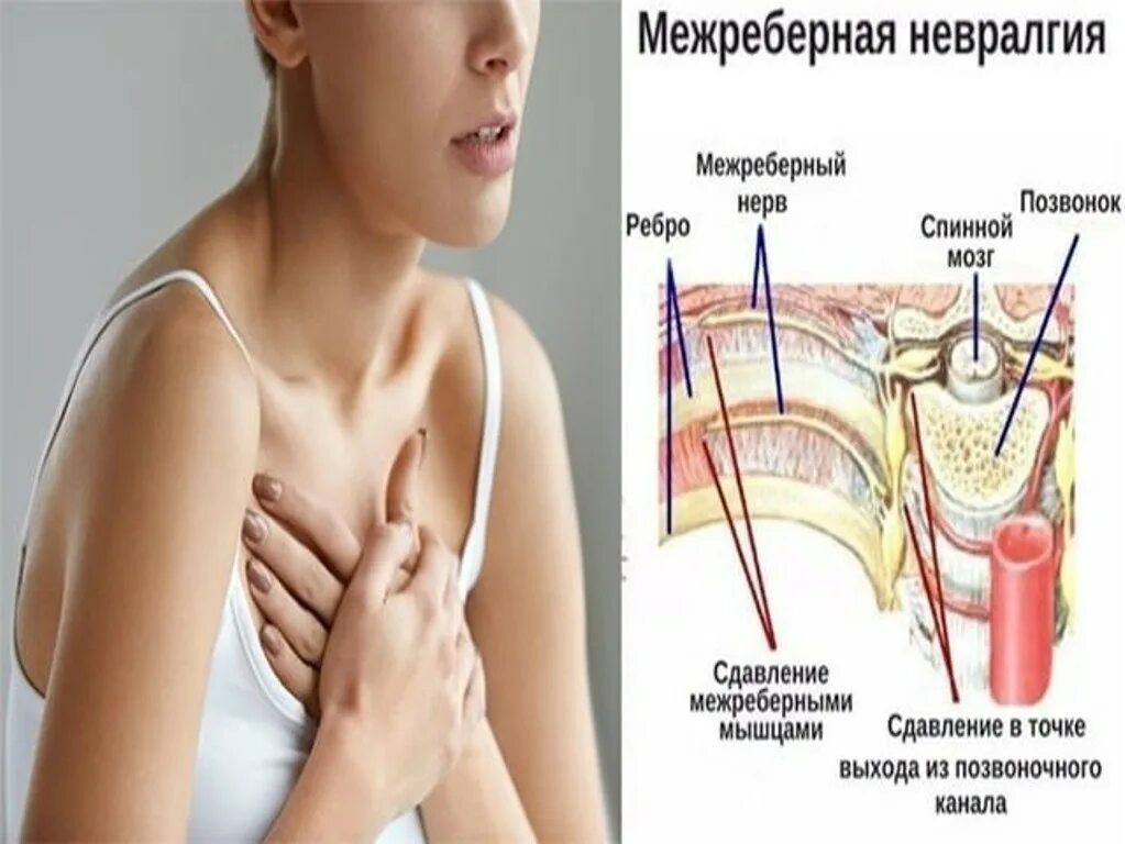 Невралгия ребра справа лечение. Неврология межреберная невралгия. межреберная невралгия симптомы. меж рёберная неврология. меж рёбырная невралгия.