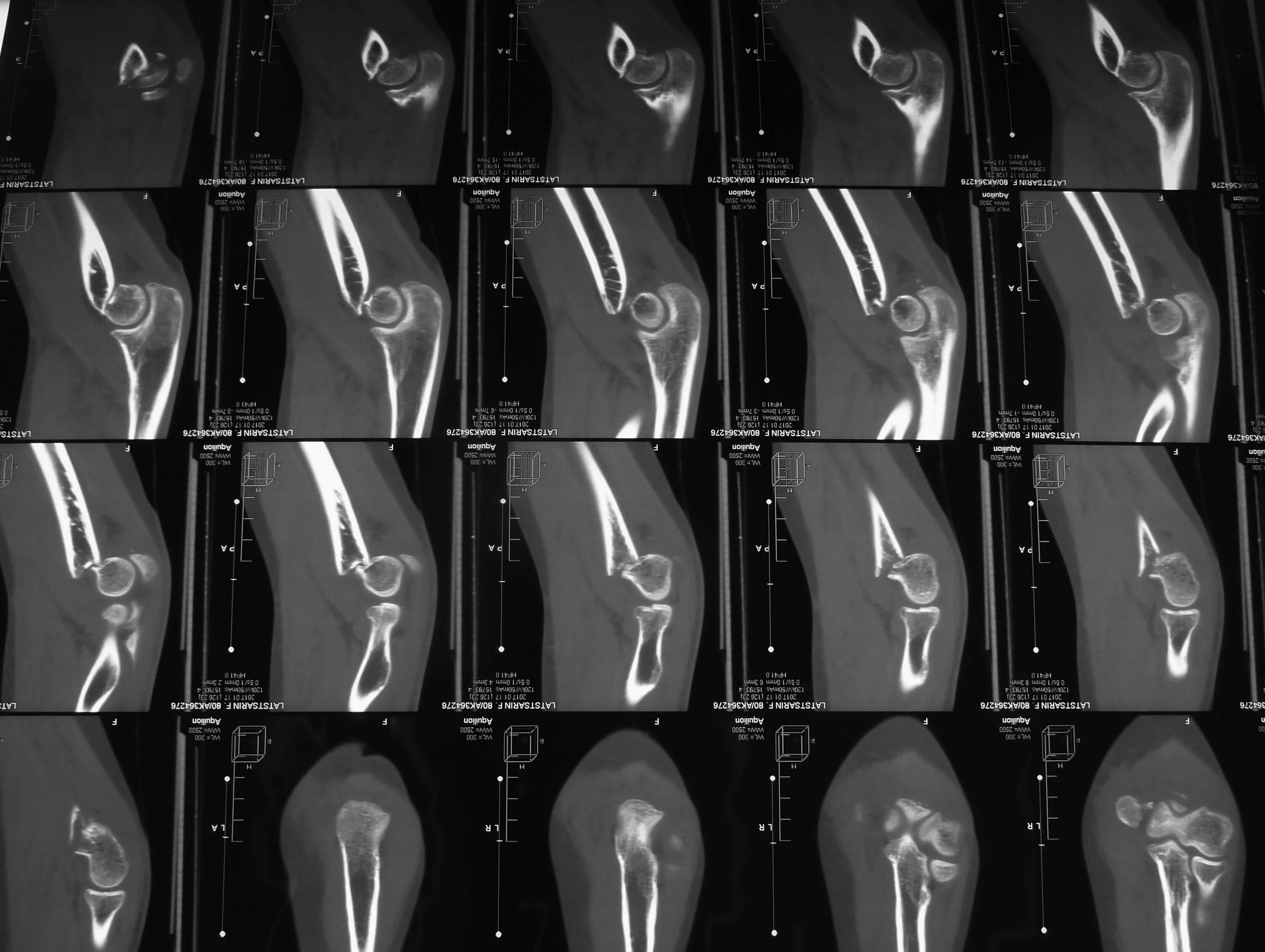 Анализ мрт коленного сустава. Мрт коленного сустава расшифровка снимка. Медиопателлярная складка анатомия. Аксил коленный сустав мрт. Мрт суставов в москве акции.