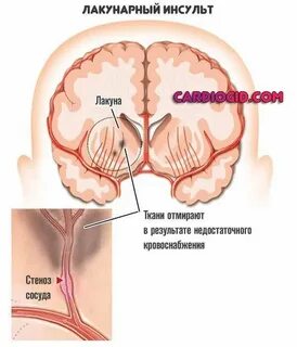 Киста после инсульта
