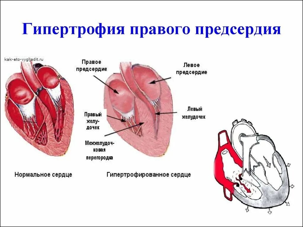 Гипертрофия правых отделов сердца. Гипертрофия левого предсердия и правого желудочка. Гипертрофия левого желудочка и предсердия. Гипертрофия миокарда левых отделов сердца что это. Желудочка сердца расширена