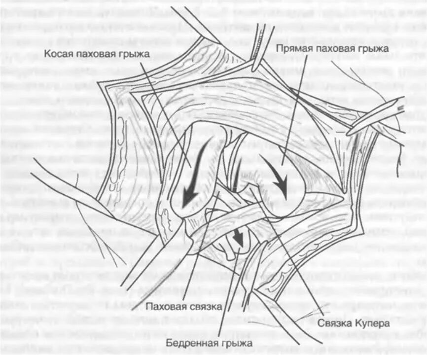 Как отличить паховую