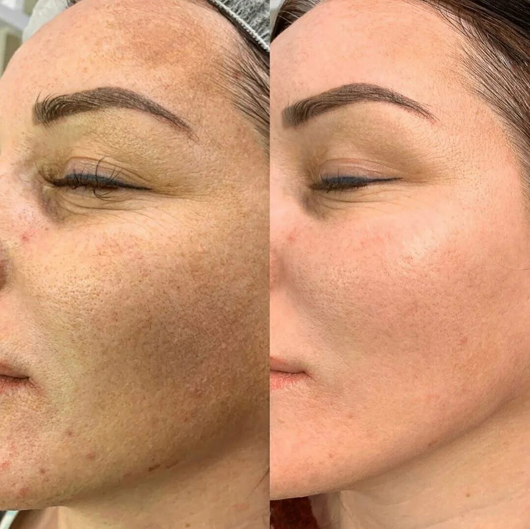 тренд косметика пилинг джесснера. голливудский пилинг джесснера. голливудский пилинг джесснера. химические пилинги для лица. пилинг inno exfo mca 35.