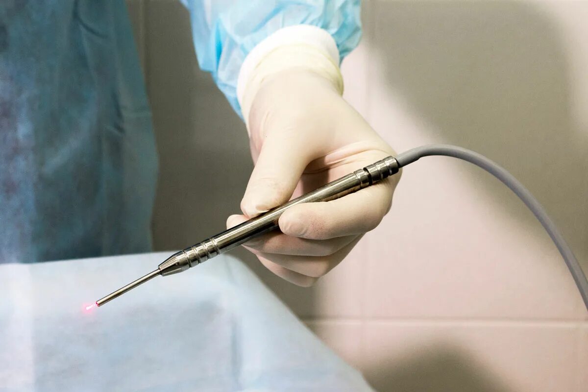 Открытая головка мужчины. Аппарат Сургитрон обрезание. Лазерный скальпель в хирургии. Обрезание радиоволновым скальпелем.