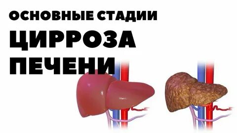 Последняя стадия цирроза печени