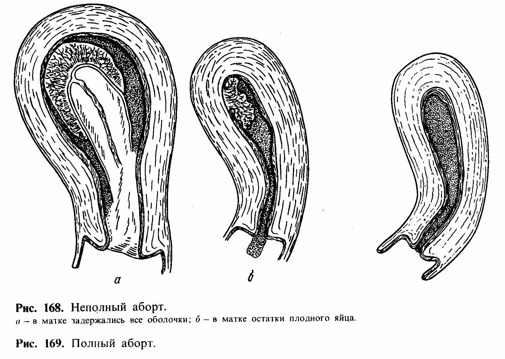 Матка после медикаментозного прерывания. Остатки оболочки плодного яйца. Самопроизвольный аборт полный неполный. Самопроизвольный выкидыш плодное яйцо. Угрожающий неполный выкидыш.