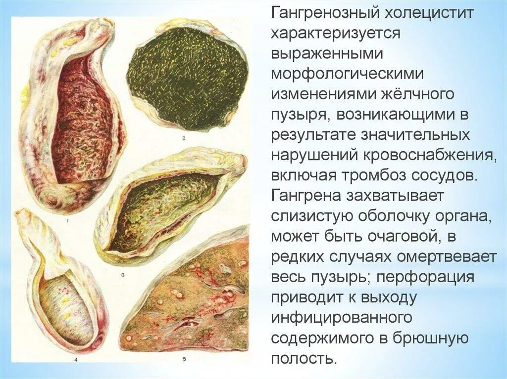 Жкб острый. Острый гангренозный калькулезный холецистит. Флегмонозный калькулезный холецистит. Острый флегмонозный холецистит. ЖКБ острый флегмонозный холецистит.