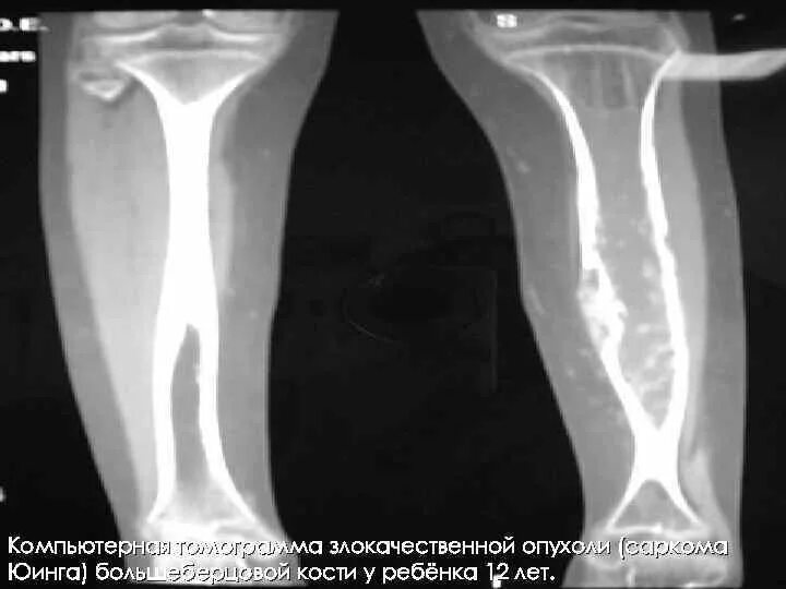Саркома юинга у детей. Саркома Юинга большеберцовой кости. Остеосаркома большеберцовой кости кт. Саркома Юинга большеберцовой кости кт.