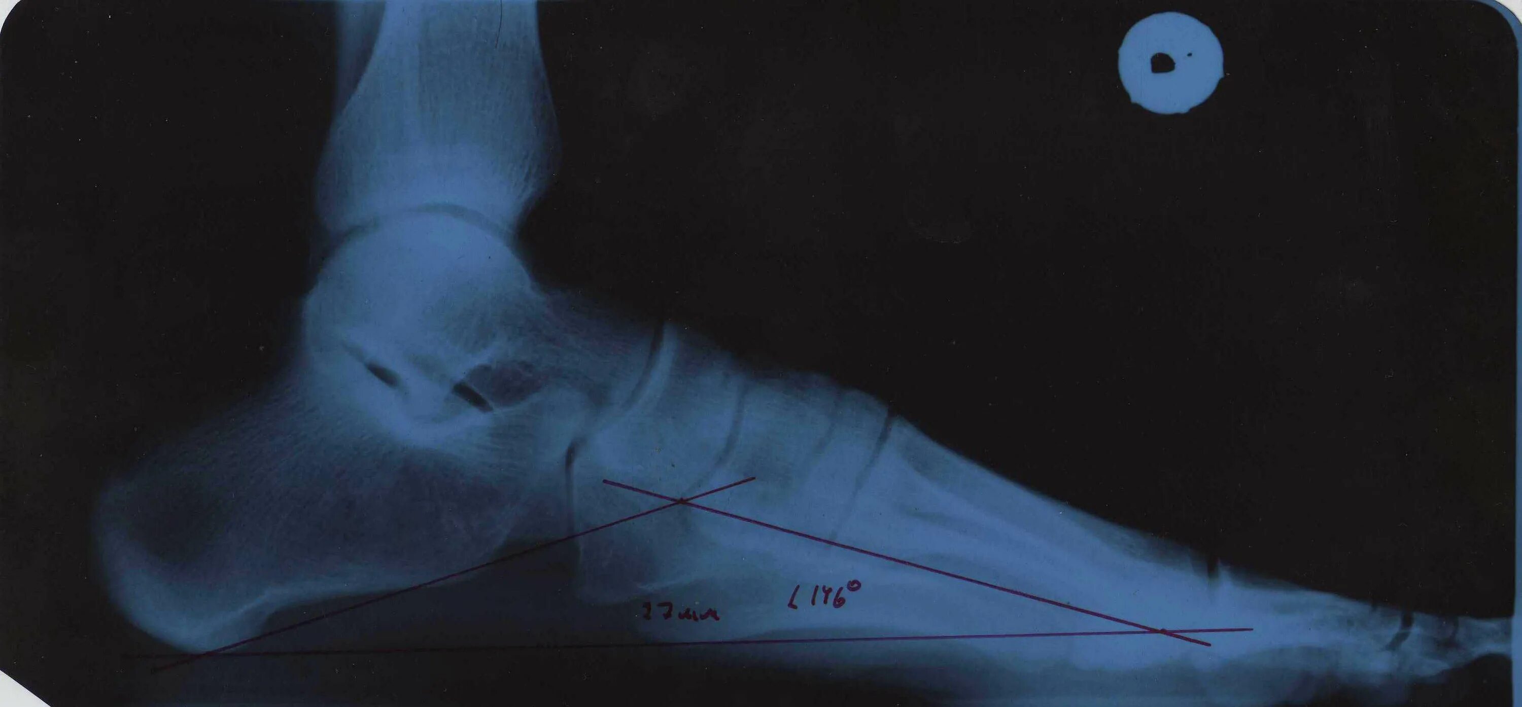Методика богданова плоскостопие рентген. Продольное вальгусное плоскостопие. Угол продольного свода 20 градусов. Поперечное плоскостопие 2 степени рентген. Поперечное плоскостопие третьей степени.