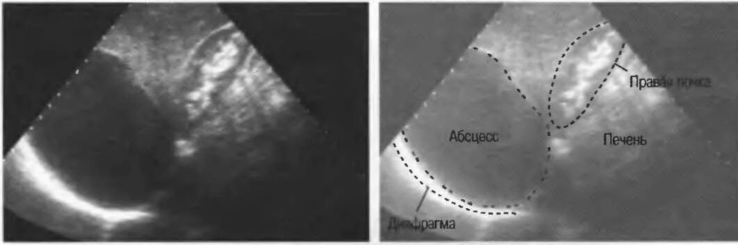 Подпеченочный абсцесс. Подпеченочный абсцесс рентген. Перивезикальн абсцесс УЗИ. Поддиафрагмальный абсцесс печени.