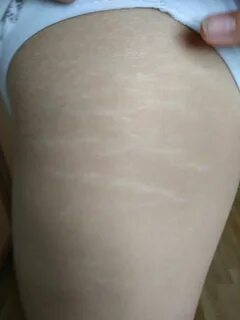 Белые линии на коже