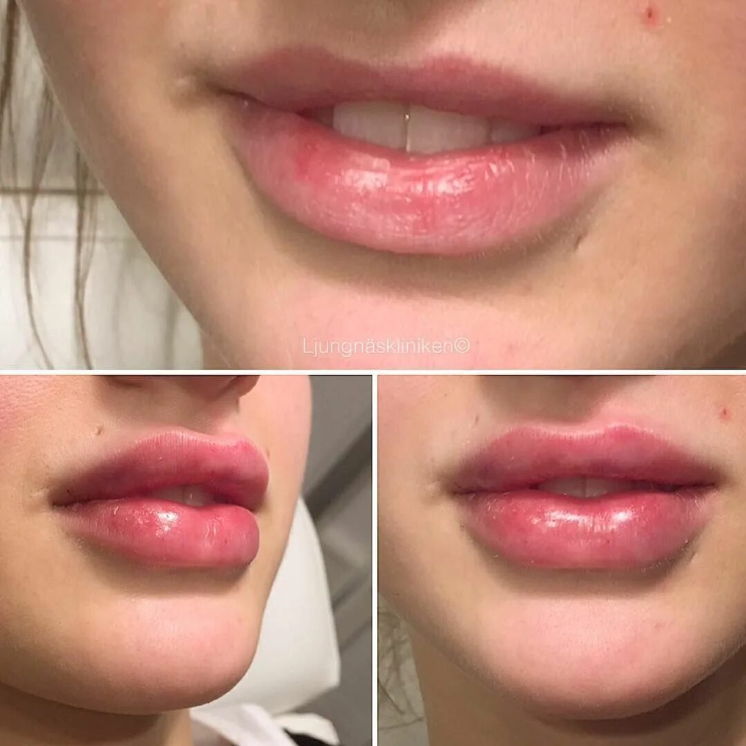 Увеличение губ lips. Губы натуральный объем.