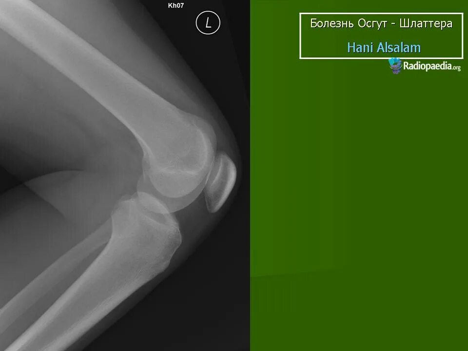 Шляттера мкб 10. Болезнь Осгуда Шлаттера клиника. Болезнь Осгуд-Шлаттера рентген. Рентген коленного сустава болезнь Осгуда Шлаттера. Осгуд Шляттера болезнь рентген.