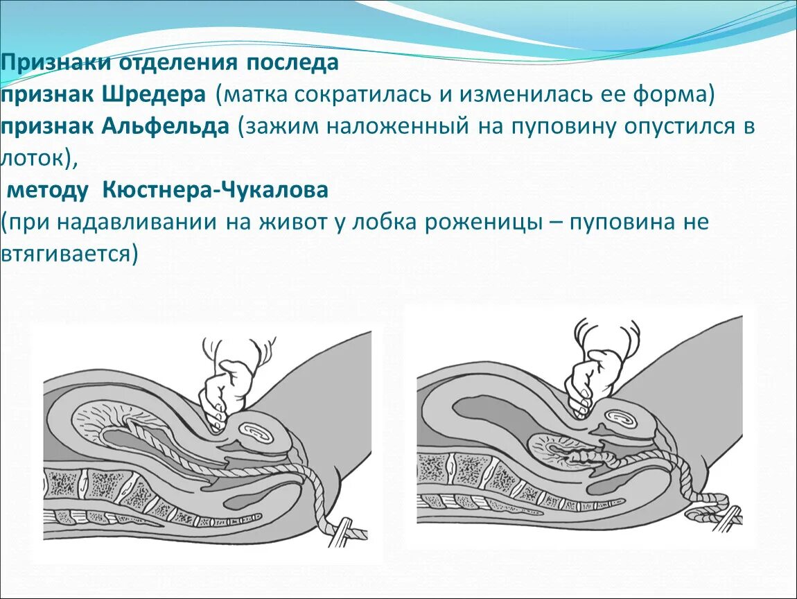 Выходит матка после родов. Признак Чукалова Кюстнера в акушерстве. Признак Альфельда в акушерстве. Признак Клейна отделение плаценты. Признак отделения последа Клейна.