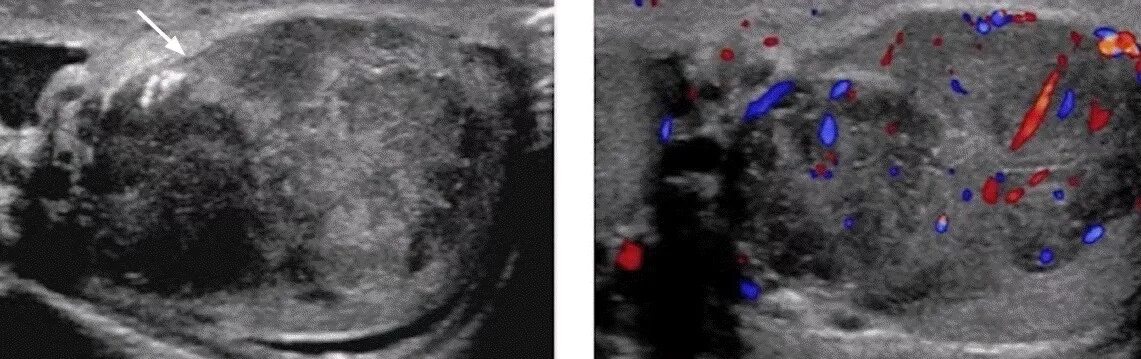 Доброкачественная опухоль яичка УЗИ. УЗИ мошонки опухоль яичка. Опухло яйцо у мужчины причины