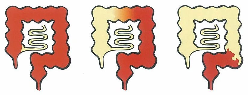 Тотальный колит. Тотальный колит. Неспецифический язвенный колит проктит. Классификация язвенного колита по локализации. Тотальный колит.