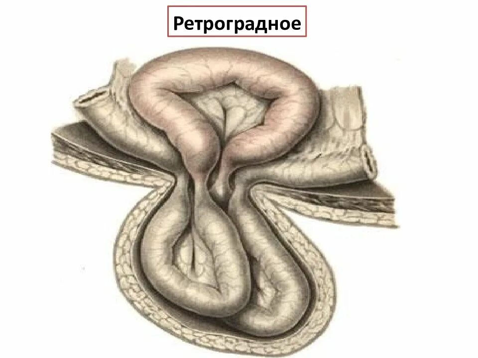 Ущемленная брюшной грыжа. Ретроградная ущемленная грыжа. Пристеночное и ретроградное ущемление грыжи. Ретроградное w образное ущемление. Ущемление грыжи Рихтера.