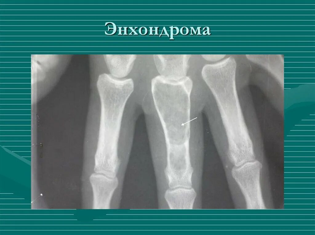 Энхондрома дистального метафиза бедренной кости. Хондросаркома плечевой кости рентген. Энхондрома коленного сустава кт. Энхондрома коленного сустава кт. Хондрома большеберцовой кости кт.