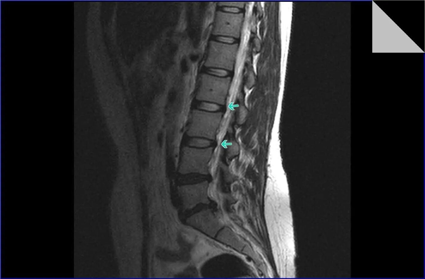 Протрузия межпозвонковых дисков у собак. Как выглядит протрузия позвоночника. Как выглядит протрузия позвоночника. Протрузия с5-с6. Грыжа диска l5-s1.