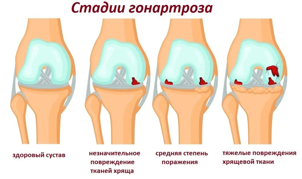 Деформирующий гонартроз коленного сустава 2-3 степени. Болезнь Кенига коленного сустава. Двусторонний гонартроз, 1ст.