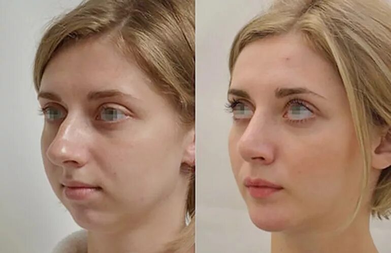 Фото ринопластики до и после нос. Доктор Поздникина ринопластика. Аугментационная ринопластика.