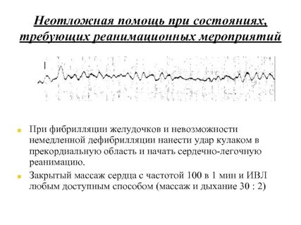 Фибрилляция помощь