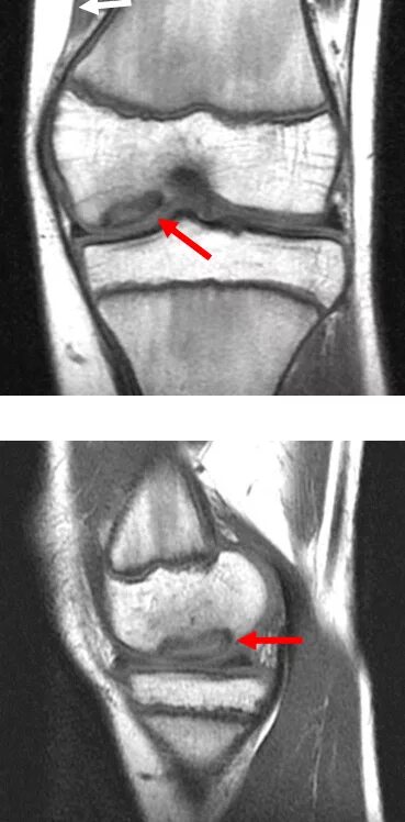 Повреждение медиального мыщелка. Рассекающий остеохондрит коленного сустава. Болезнь Кёнига рассекающий остеохондрит. Остеохондрит коленного сустава мрт. Рассекающий остеохондрит коленного сустава мрт.