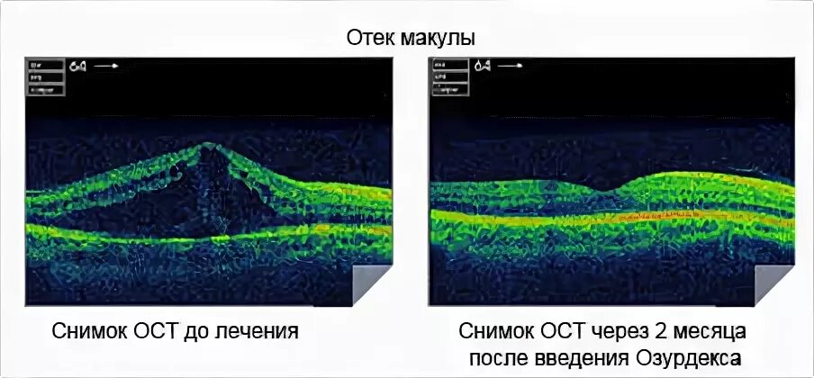 Макулярный отек лечение. Оптическая когерентная томография макулы. Макулярный разрыв сетчатки ОСТ. Макулопатия макулярный отек. Макулярный фиброз сетчатки.