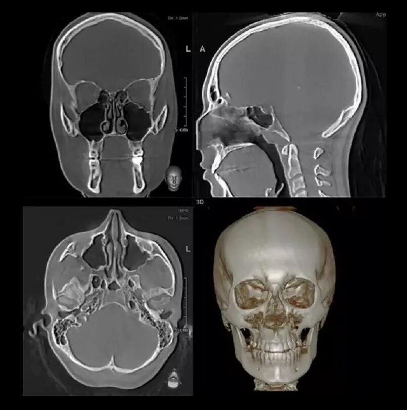Остеомиелит костей черепа на кт. Миелома костей черепа на кт. Гиперостоз костей черепа на кт. Снимок черепа сбоку кт. Кт реконструкция