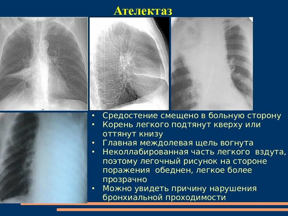 Признаки ателектаза легкого. Ателектаз доли рентген. Ателектаз доли легкого рентген. Ателектаз s3. Ателектаз средней доли правого легкого рентген.