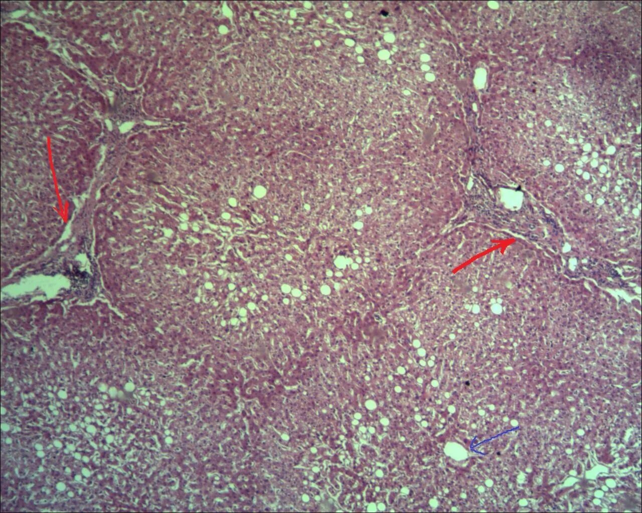 Перипортальный фиброз печени микропрепарат. Перипортальный фиброз печени. Перивенулярный фиброз печени. Периваскулярный фиброз печени. Что такое стеатоз поджелудочной железы