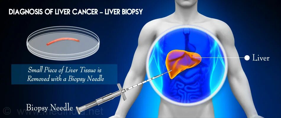 Пункционная биопсия печени. Чрескожная лапароскопическая биопсия печени,.