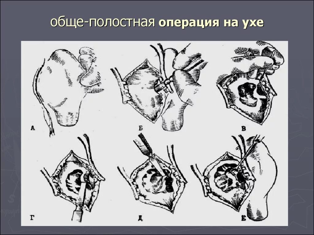 Операция на среднем ухе. Расширенная общеполостная операция на среднем ухе. Расширенная санирующая операция на среднем ухе. Санирующая радикальная операция на ухе. Радикальная общеполостная операция.