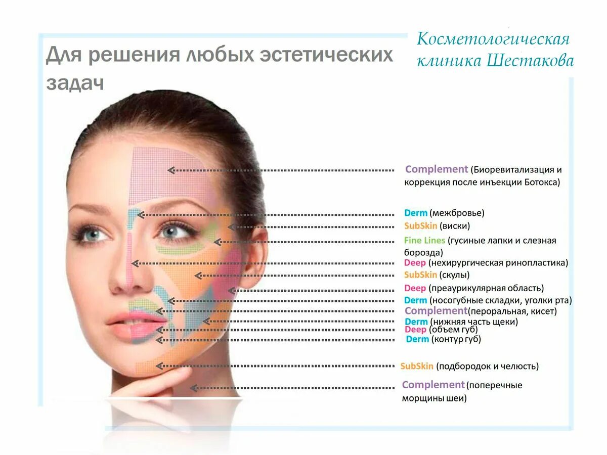 Как колоть филлер. Схема введения ботокса в межбровье. Схема введения ботулотоксина в лоб. Зоны для ботокса на лице. Схема введения ботокса на лице.