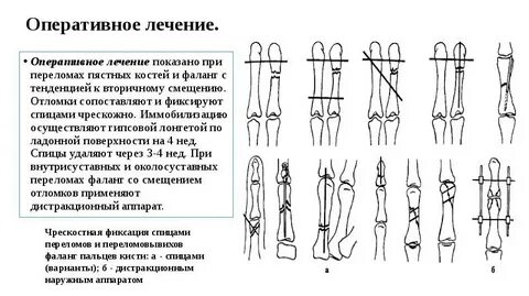 При каких переломах ставят спицу