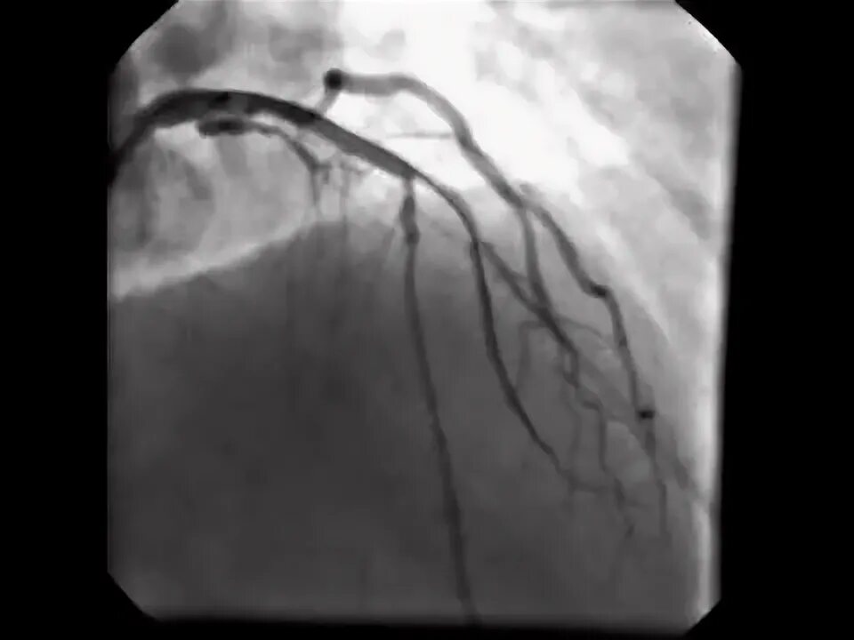 Коронарография стеноз пмжв. Коронарография стеноз пмжв. Стентирование пмжв. Стентирование пмжв сте. Стентирование пмжв.
