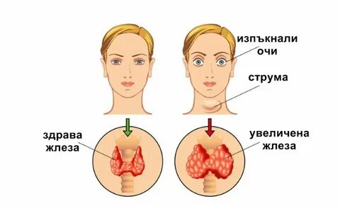 Заболевание щитовидной железы тиреотоксикоз