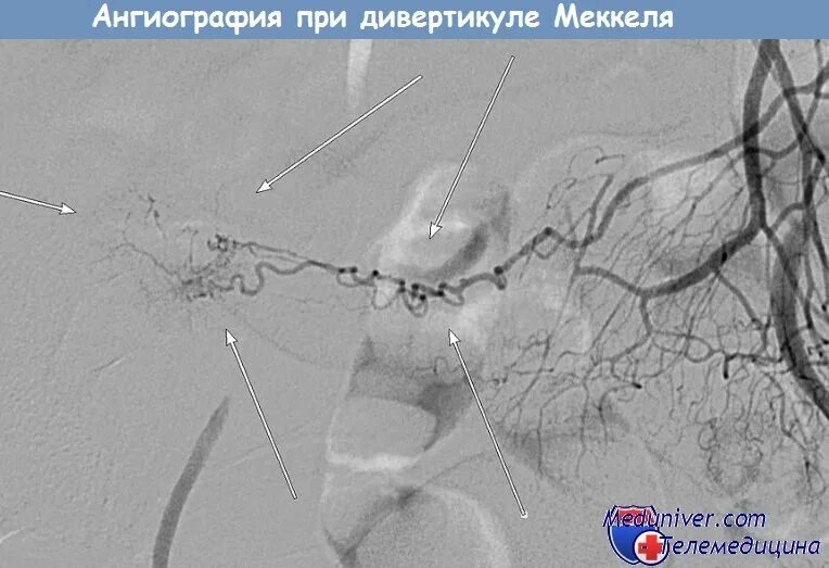 Эмболизация гемангиомы
