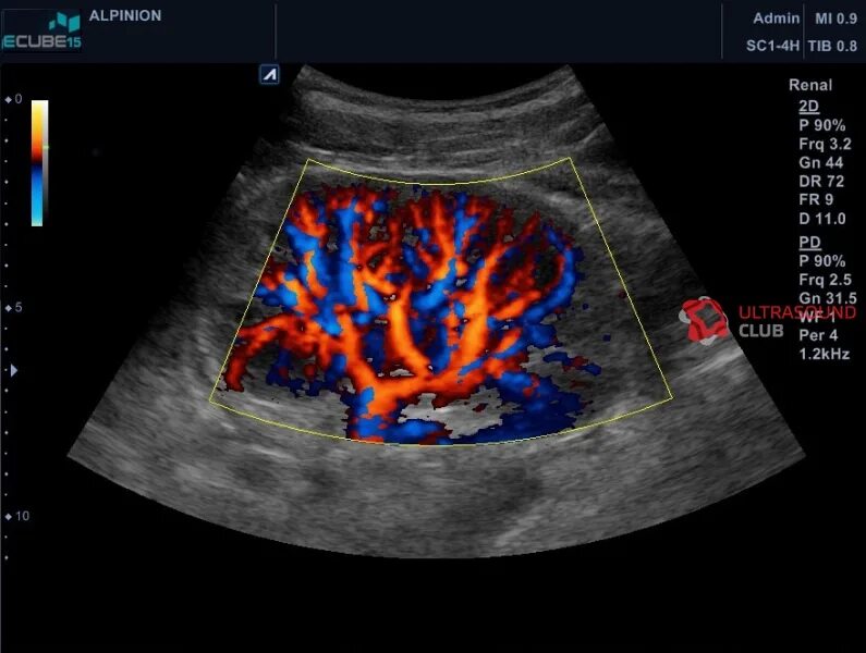 Доплер кровотоки. Ультразвуковая допплерография почечных вен. Исследование почечных артерий дуплексное. Допплеровское сканирование сосудов почек. УЗИ почек допплер сосудов почек.