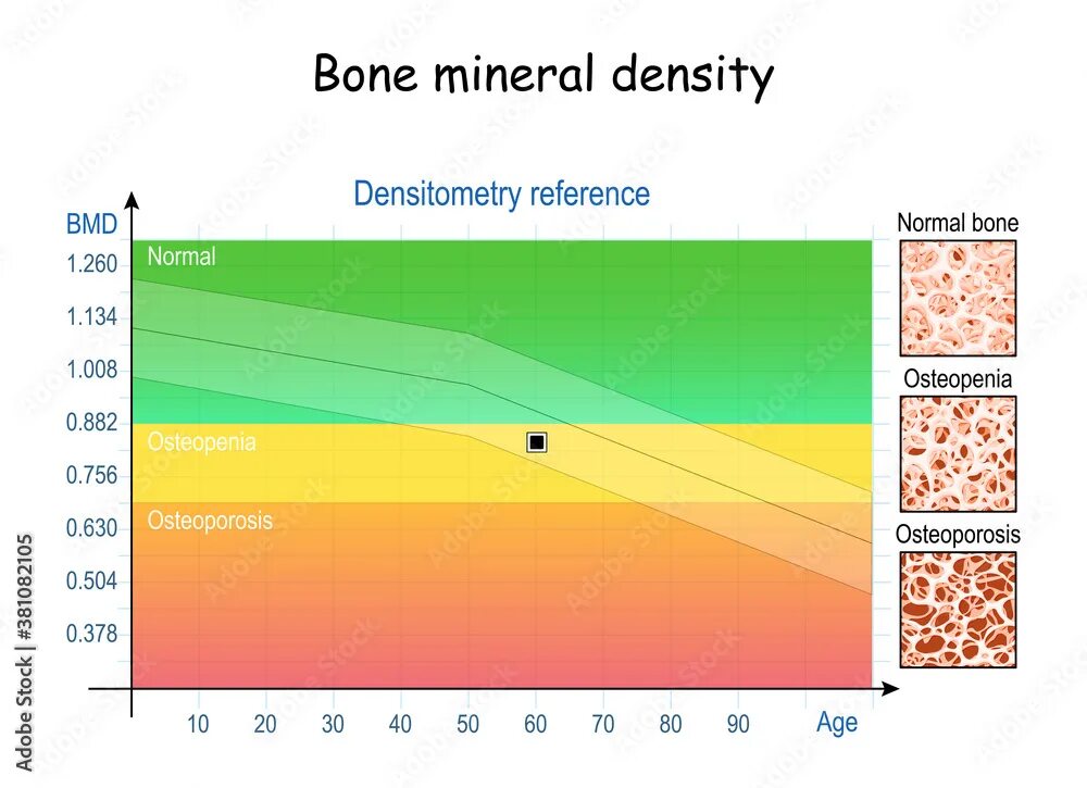 Bone mineral