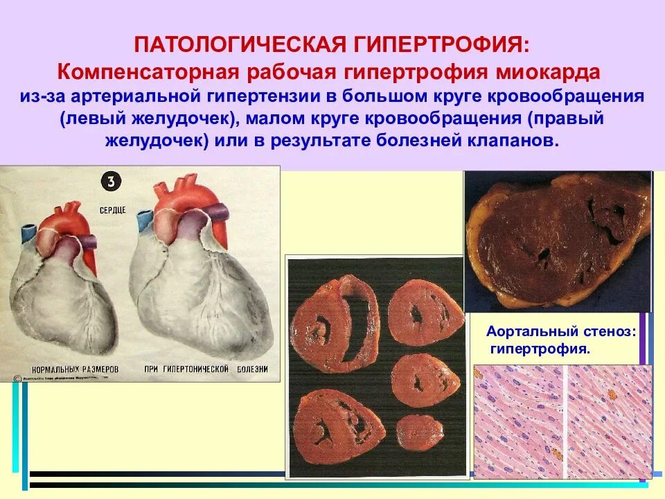 Гипертрофия что это. Гипертрофия миокарда причины патологическая анатомия. Гипертрофия миокарда исход патологическая анатомия. Проявления физиологической гипертрофии миокарда. Гипертрофия сердца патанатомия.