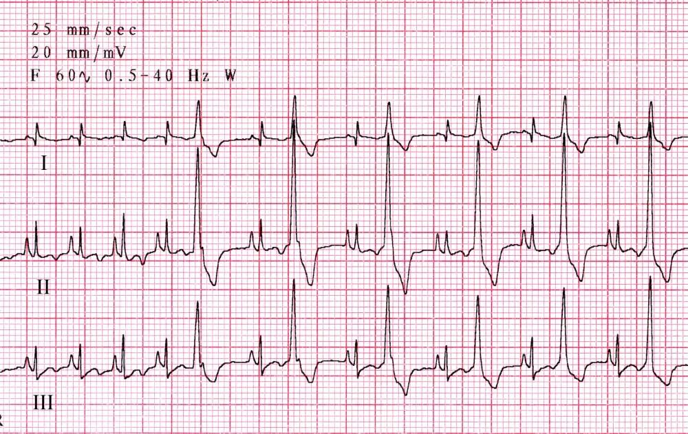 Аберрантная наджелудочковая экстрасистолия на экг. Heart rhythm disorder. Предсердная экстрасистолия на экг. Ступени диагностического поиска. Кампанула розовая.